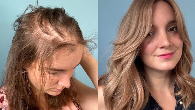 Gard : alopécie féminine, Laure Saujet met en lumière les solutions existantes